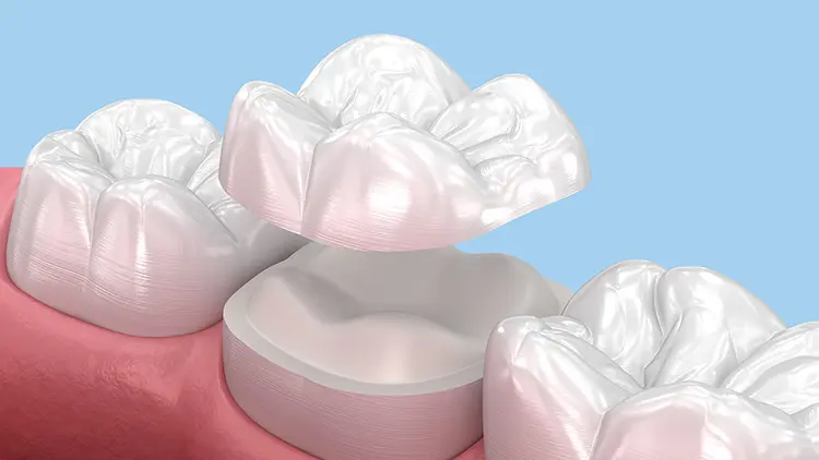 セラミック治療で口臭が発生する原因の画像