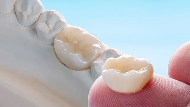 セラミックインレーの種類の画像