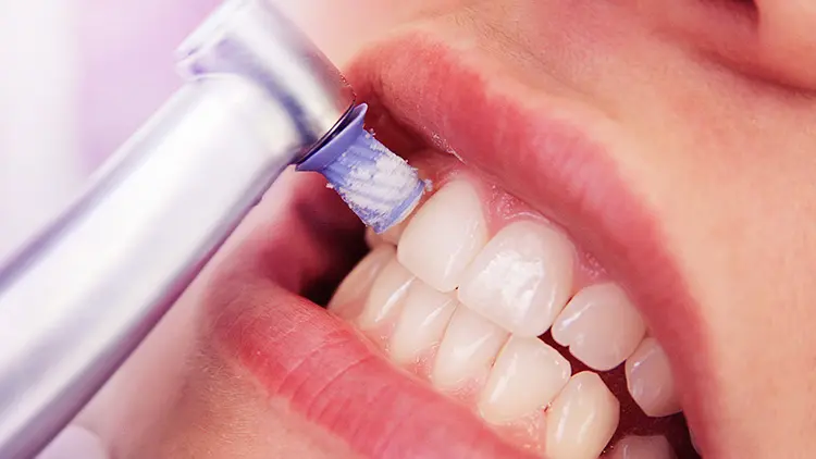 変色したレジンの主な5つの治療法と、それぞれの特徴の画像