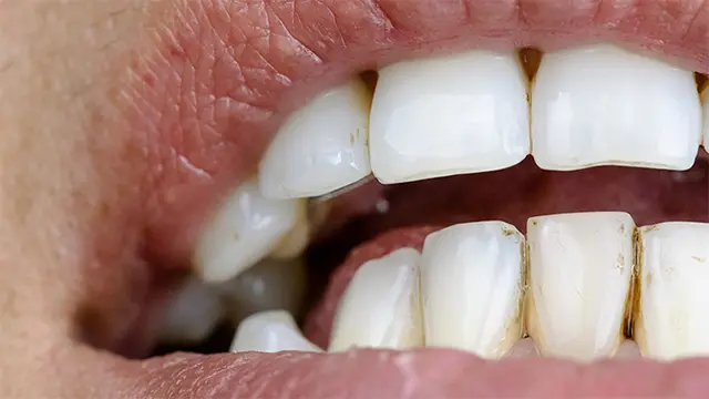 あなたの前歯の黒ずみはどのタイプ？症状から考える原因の見分け方の画像