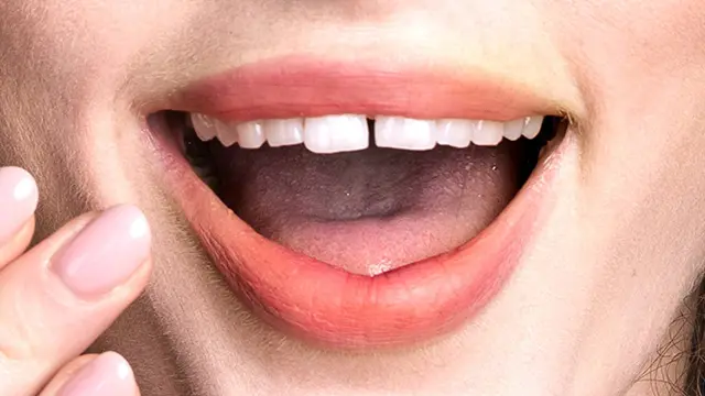 前歯の隙間ができる主な理由の画像