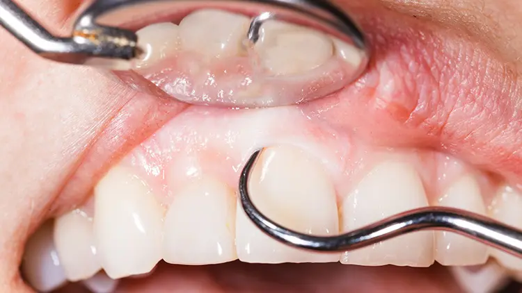 歯茎が白くなったときに考えられる主な疾患の画像