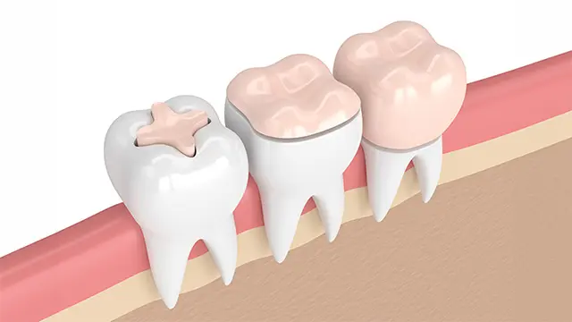 歯の表面以外の着色汚れの場合の画像