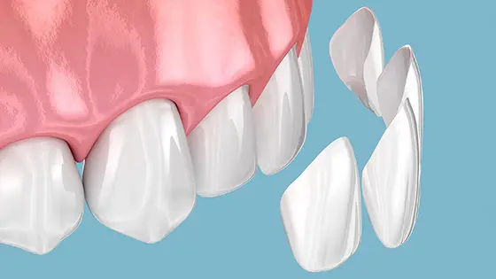 セラミック治療ができるおすすめ歯医者の画像