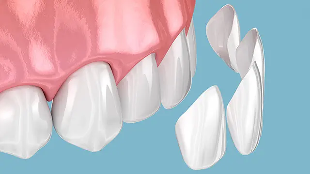 セラミック治療とは？の画像